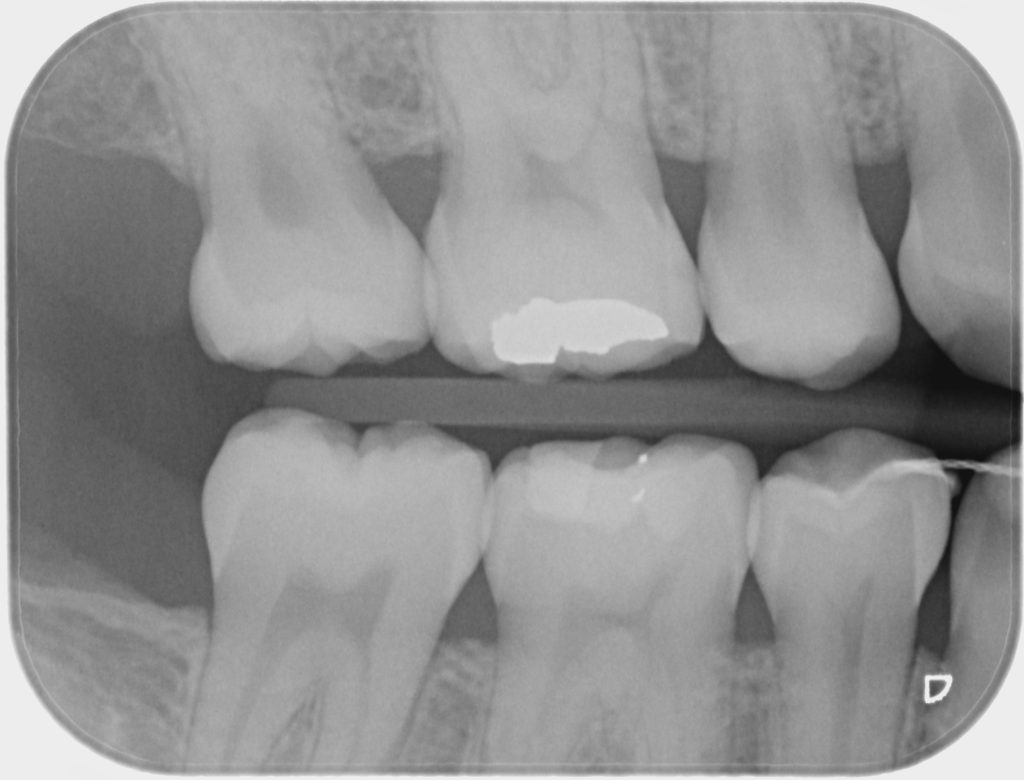 Radiografía bitewing