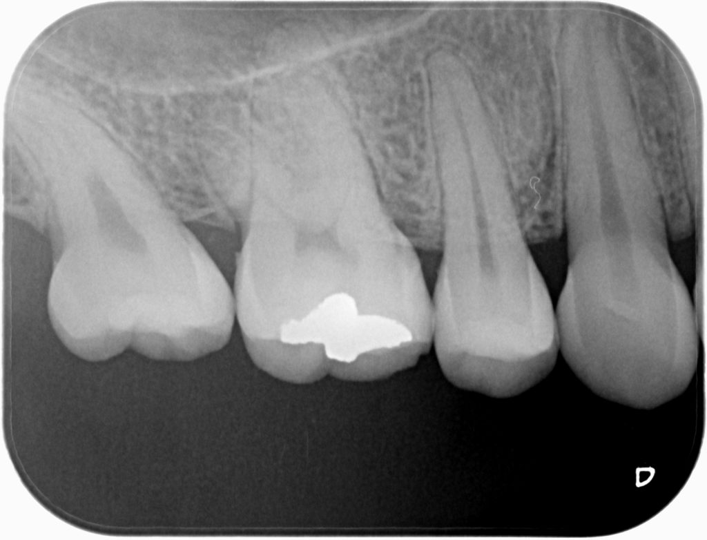 Radiografía Periapical